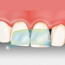Lipni plastikinė matrica Dispens-O-Mat Anterior 7 mm, 100 vnt. Lipni plastikinė matrica Dispens-O-Mat Anterior 7 mm, 100 vnt.