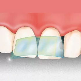 Lipni plastikinė matrica Dispens-O-Mat Anterior 7 mm, 100 vnt.