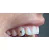 Tooth jewelry Heart Diamond